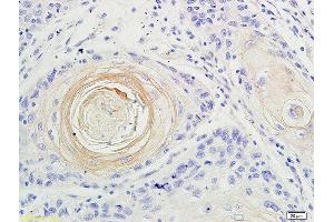 Formalin-fixed and paraffin embedded human oral squamous cell carcinoma labeled with Anti-IL-17 Polyclonal Antibody, Unconjugated at 1:200 followed by conjugation to the secondary antibody and DAB staining (IL-17 antibody  (AA 35-130))