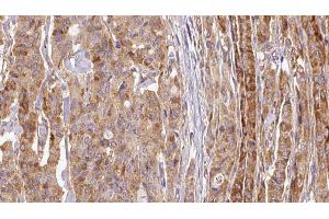 ABIN6267114 at 1/100 staining Human thyroid cancer tissue by IHC-P. (EEF2K antibody  (pSer366))