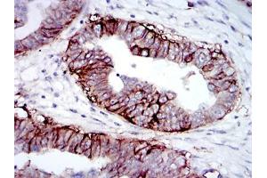 Immunohistochemical analysis of paraffin-embedded ovarian cancer tissues using IGF1R-Beta mouse mAb with DAB staining. (IGF1R antibody  (AA 1101-1367))