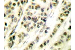 Immunohistochemistry analyzes of Skp1 p19 antibody in paraffin-embedded human breast carcinoma tissue. (SKP1 antibody)