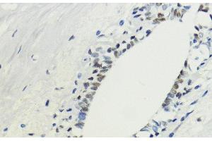 Immunohistochemistry of paraffin-embedded Human breast using TriMethyl-Histone H3-K36 Polyclonal Antibody at dilution of 1:200 (40x lens). (Histone 3 antibody  (3meLys36))