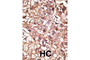 Formalin-fixed and paraffin-embedded human hepatocellular carcinoma tissue reacted with STUB1 polyclonal antibody  , which was peroxidase-conjugated to the secondary antibody, followed by AEC staining. (STUB1 antibody  (AA 160-190))