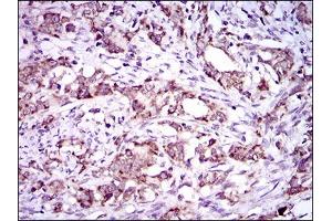 Immunohistochemical analysis of paraffin-embedded cervical cancer tissues using DNAL4 mouse mAb with DAB staining. (DNAL4 antibody  (AA 1-105))