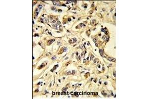 Formalin-fixed and paraffin-embedded human breast carcinoma reacted with VGFR1 Antibody, which was peroxidase-conjugated to the secondary antibody, followed by DAB staining. (FLT1 antibody)