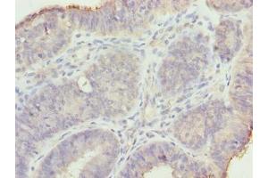 Immunohistochemistry of paraffin-embedded human endometrial cancer using ABIN7159191 at dilution of 1:100 (MND1 antibody  (AA 2-205))