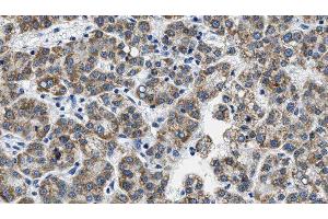 ABIN6276063 at 1/100 staining Human liver cancer tissue by IHC-P. (NPY5R antibody  (Internal Region))