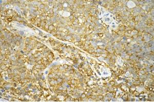 Immunohistochemistry was performed on paraffin-embedded human breast carcinoma using STAT1 antibody (ABIN7800336), 1:200). (Recombinant STAT1 antibody)