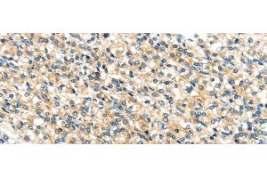 Immunohistochemistry of paraffin-embedded Human prostate cancer tissue using TTI1 Polyclonal Antibody at dilution 1:40 (TTI1 antibody)