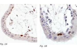 Immunohistochemistry (IHC) image for anti-Tumor Protein P53 (TP53) (AA 378-393), (C-Term), (pSer392) antibody (ABIN238404)