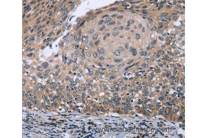 Immunohistochemistry of Human cervical cancer using RNF144B Polyclonal Antibody at dilution of 1:50 (RNF144B antibody)