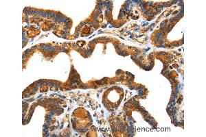 Immunohistochemistry of Human thyroid cancer using SPARC Polyclonal Antibody at dilution of 1:25