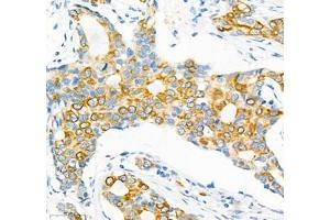 Immunohistochemistry of paraffin embedded human breast cancer using Epl4 (ABIN7073843) at dilution of 1:2000 (400x lens) (EFNA4 antibody)