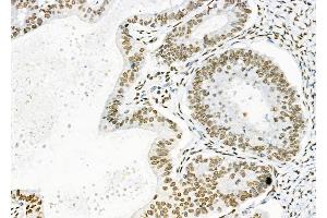 ABIN6261287 and ABIN6279346 at 1/100 staining human ovarian cancer by IHC-P.