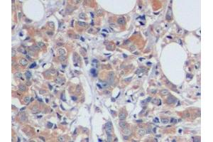 Detection of CA125 in Human Breast cancer Tissue using Polyclonal Antibody to Carbohydrate Antigen 125 (CA125) (MUC16 antibody  (AA 13977-14117))