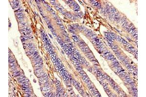 Immunohistochemistry of paraffin-embedded human colon cancer using ABIN7151326 at dilution of 1:100 (EEA1 antibody  (AA 734-875))
