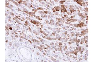 IHC-P Image Immunohistochemical analysis of paraffin-embedded MDA-MB-468 xenograft , using AKR1C1, antibody at 1:500 dilution. (AKR1C1 antibody)