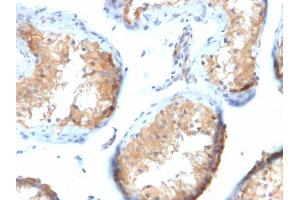 Formalin-fixed, paraffin-embedded human Testicular Carcinoma stained with Vinculin Mouse Monoclonal Antibody (VCL/2573).