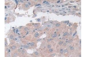 Detection of ASAH1 in Human Breast cancer Tissue using Polyclonal Antibody to N-Acylsphingosine Amidohydrolase 1 (ASAH1) (ASAH1 antibody  (AA 144-395))