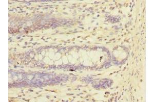 Immunohistochemistry of paraffin-embedded human colon cancer using ABIN7151244 at dilution of 1:100 (TRIM17 / RNF16 antibody  (AA 1-300))