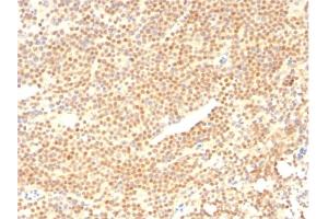 Formalin-fixed, paraffin-embedded human Mantle Cell Lymphoma stained with Cyclin D1 Mouse Monoclonal Antibody (CCND1/2593). (Cyclin D1 antibody)