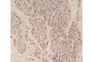 IHC-P analysis of Human Esophagus Cancer Tissue, with DAB staining. (Caspase 3 antibody  (AA 29-175))
