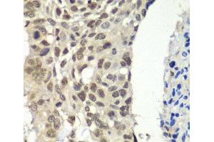 Immunohistochemistry of paraffin-embedded Human esophageal cancer using SSRP1 Polyclonal Antibody at dilution of 1:100 (40x lens).