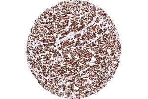 Heart muscle exhibiting a strong granular cytoplasmic SDHA staining