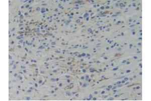IHC-P analysis of Human Prostate Gland Cancer Tissue, with DAB staining. (WARS antibody  (AA 247-458))