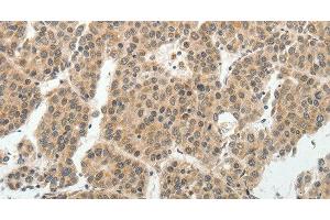 Immunohistochemistry of paraffin-embedded Human liver cancer tissue using SOCS7 Polyclonal Antibody at dilution 1:30