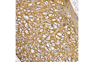Immunohistochemistry of paraffin-embedded Human esophageal cancer using Cytokeratin 19 (KRT19) antibody (ABIN7268099) at dilution of 1:100 (40x lens). (Cytokeratin 19 antibody)