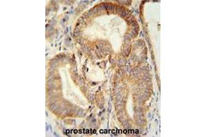 CLDN7 antibody (C-term) immunohistochemistry analysis in formalin fixed and paraffin embedded human prostate carcinoma followed by peroxidase conjugation of the secondary antibody and DAB staining. (Claudin 7 antibody  (C-Term))