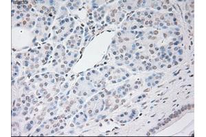 Immunohistochemical staining of paraffin-embedded Adenocarcinoma of breast tissue using anti-VEGF mouse monoclonal antibody. (VEGF antibody  (AA 27-233))