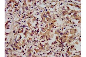 IHC image of ABIN7143473 diluted at 1:300 and staining in paraffin-embedded human liver cancer performed on a Leica BondTM system. (ARL1 antibody  (AA 2-181))