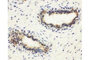 Anti-HLA DMB antibody, IHC(P) IHC(P): Human Mammary Cancer Tissue (HLA-DMB antibody  (Middle Region))