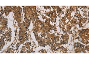 Immunohistochemistry of paraffin-embedded Human colon cancer using CORO1C Polyclonal Antibody at dilution of 1:60 (CORO1C antibody)
