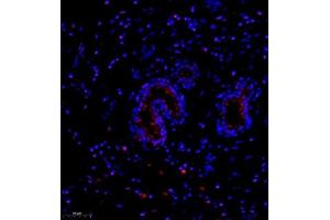 Immunofluorescence of paraffin embedded human breast cancer using NCK (ABIN7074783) at dilution of 1:1000 (250x lens)