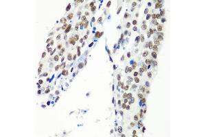 Immunohistochemistry of paraffin-embedded human lung cancer using HTATSF1 antibody (ABIN5973562) at dilution of 1/100 (40x lens). (HTATSF1 antibody)