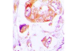 Immunohistochemical analysis of CK1 alpha staining in human lung cancer formalin fixed paraffin embedded tissue section. (CSNK1A1 antibody  (Center))