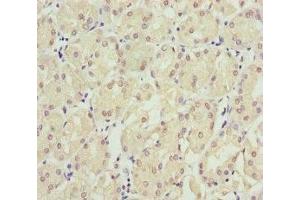 Immunohistochemistry of paraffin-embedded human gastric cancer using ABIN7151953 at dilution of 1:100 (Eppin antibody  (AA 22-133))