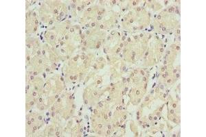 Immunohistochemistry of paraffin-embedded human gastric cancer using ABIN7151953 at dilution of 1:100 (Eppin antibody  (AA 22-133))