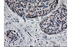 Immunohistochemical staining of paraffin-embedded Carcinoma of Human pancreas tissue using anti-TMOD1 mouse monoclonal antibody.