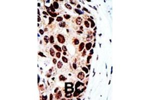 Formalin-fixed and paraffin-embedded human cancer tissue reacted with the primary antibody, which was peroxidase-conjugated to the secondary antibody, followed by DAB staining. (HDAC9 antibody  (C-Term))