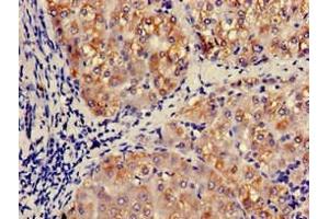 Immunohistochemistry of paraffin-embedded human liver tissue using ABIN7145998 at dilution of 1:100 (CCL3 antibody  (AA 25-81))