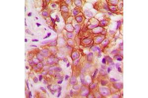 Immunohistochemical analysis of FYN (pY530) staining in human breast cancer formalin fixed paraffin embedded tissue section. (FYN antibody  (C-Term, pTyr530))