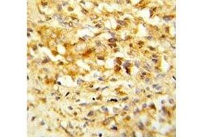 IHC analysis of FFPE human prostate carcinoma stained with NKX3. (NKX3-1 antibody  (AA 118-145))