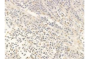 ABIN6266072 and ABIN6266816 at 1/100 staining human non-Hodgkin lymphoma by IHC-P. (XRN2 antibody  (N-Term))