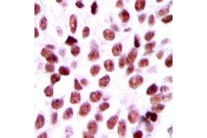 Immunohistochemical analysis of BCA3 staining in human breast cancer formalin fixed paraffin embedded tissue section.