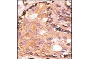 Formalin-fixed and paraffin-embedded human cancer tissue reacted with the primary antibody, which was peroxidase-conjugated to the secondary antibody, followed by AEC staining. (DUSP4 antibody  (C-Term))