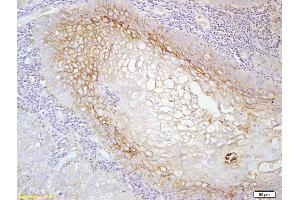 Formalin-fixed and paraffin embedded human laryngeal cancer labeled with Anti-MCSF ReceptorPolyclonal Antibody, Unconjugated (ABIN750143) at 1:200 followed by conjugation to the secondary antibody and DAB staining (CSF1R antibody  (AA 201-300))