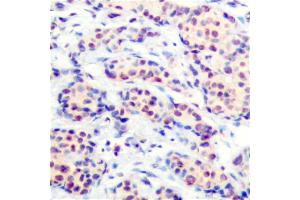 Immunohistochemical analysis of paraffin-embedded human breast carcinoma tissue using JunD (Ab-255) antibody (#B7137).